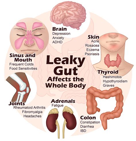 Step Formula To Heal Leaky Gut Naturally Paula Owens