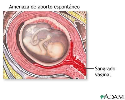 Aborto Espont Neo Causas S Ntomas Tipos De Aborto Y Tratamiento