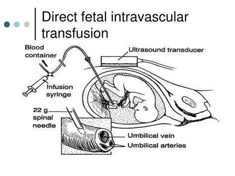 Fetal Blood Transfusion