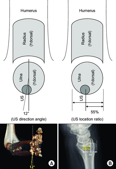 The Absolute Location Of The Ulnar Styloid Process On The Axial Plane Download Scientific