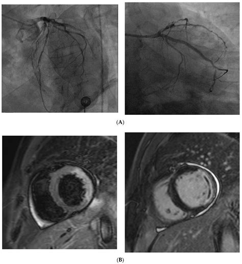 Coronary Microvascular Dysfunction
