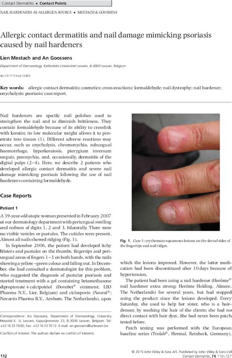 Allergic Contact Dermatitis And Nail Damage Mimicking Psoriasis Caused