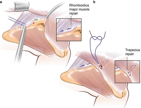 Scapular Muscle Detachment Musculoskeletal Key