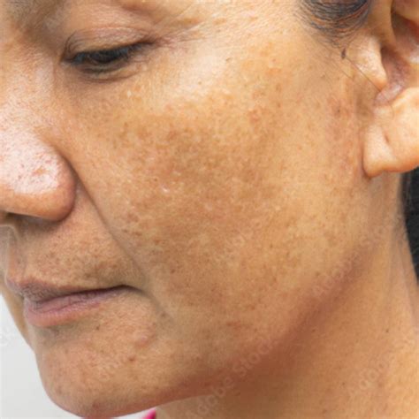 The Types Of Pigmentation And How To Treat Them Skinmart