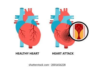 Healthy Unhealthy Heart Heart Atherosclerotic Plaque Stock Vector