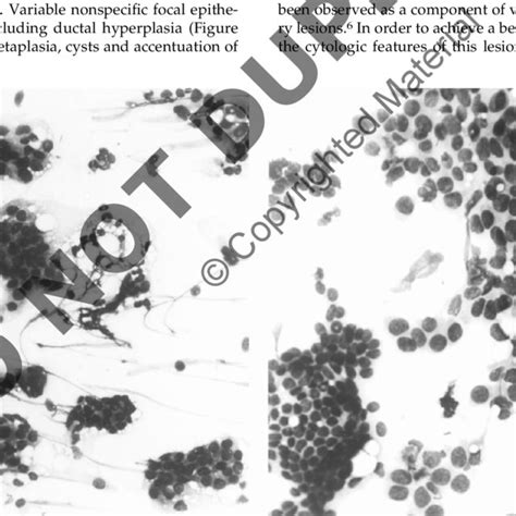 Smears From Patient 6 Showing A Atypia And Cellular Dissociation Download Scientific Diagram