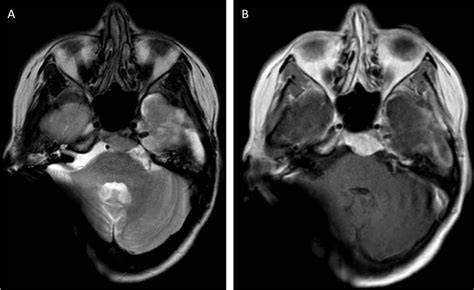 First MRI With New Cochlear Implant With Rotatable Internal ...