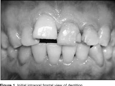 Figure 1 From Orthodontic Treatment Of An Ankylosed Maxillary Central Incisor Through Osteogenic