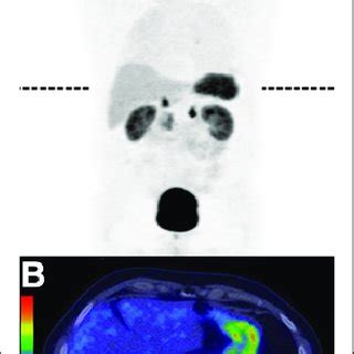 Biodistribution of 175 MBq of 68 Ga OPS202 15 μg 1 h after injection