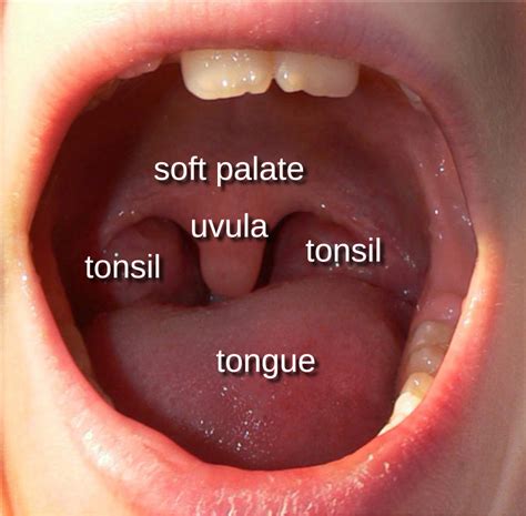 Deviated Uvula Sore Throat