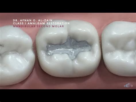 Class Ii Cavity Preparation For Amalgam Mandibular Molar Off