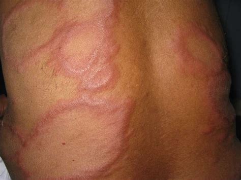 Leprosy: what everyone should know - dermacosm