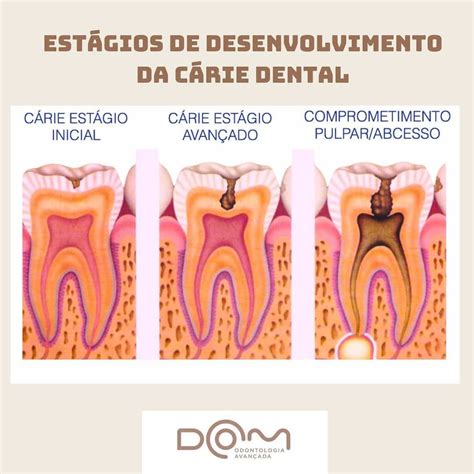 Como Se Desenvolve A Carie - Como se desenvolve a cárie? - Dom Odontologia Avançada saúde bucal