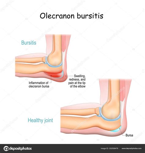 Elbow Anatomy Olecranon