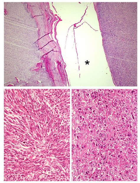 Dedifferentiated Chondrosarcoma Is Characterized By The Coexistence Of Download Scientific