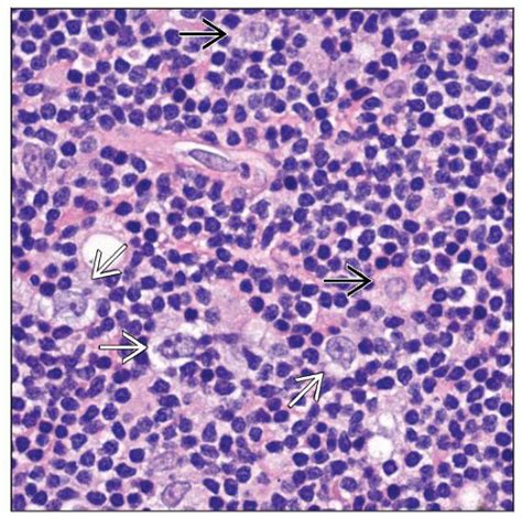 T Cell Histiocyte Rich Large B Cell Lymphoma Basicmedical Key