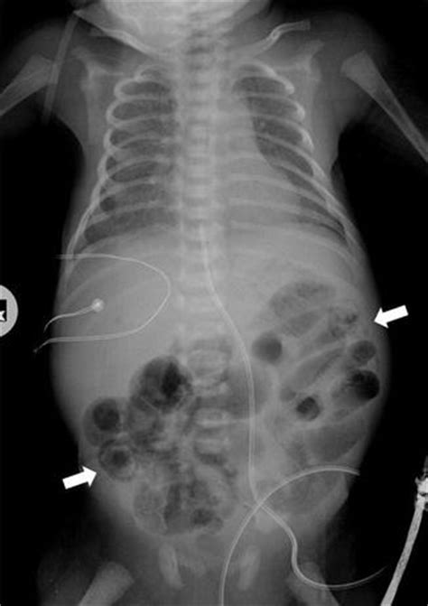 Imaging Of Gastrointestinal Tract Perforation In The Pediatric Patient