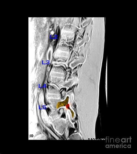 Mri Of L5 Spondylolysis Photograph By Living Art Enterprises