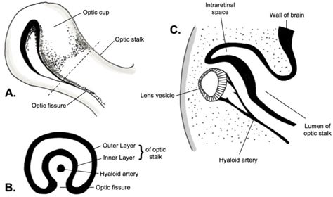 Figure Embryology Of The Optic Fissure Statpearls Ncbi Bookshelf