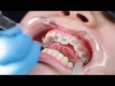 Como se Ponen los Brackets Instalación de Frenillos Paso a Paso