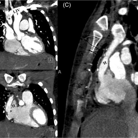 Ac Postoperative Computed Tomography Images Showing A Widely