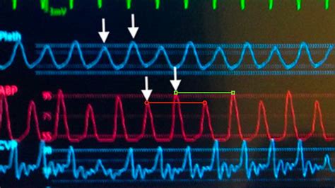 Pulsus Alternans And The Menacing Metronome