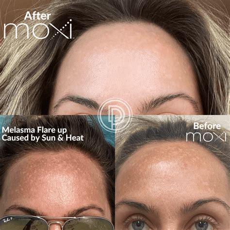 Sciton Moxi Laser Treatment Dallas Dermatology Partners