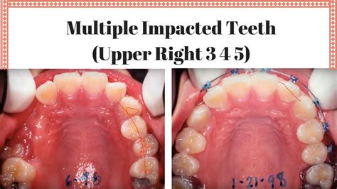 Multiple Impacted Teeth Upper Right 3 4 5 YouTube