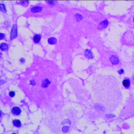 Bone Marrow Trephine Biopsy Specimen Histological Assessment Revealed