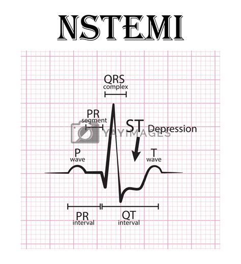 Non St Elevation Myocardial Infarction Renew Physical Therapy