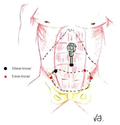 Laparoscopic Radical Prostatectomy Intechopen