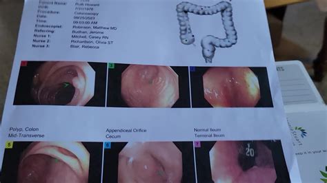 COLONOSCOPY REVEALS THAT I HAVE POLYPS