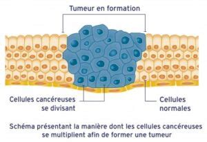 Comment Se Forme Une Tumeur Fondation Contre Le Cancer