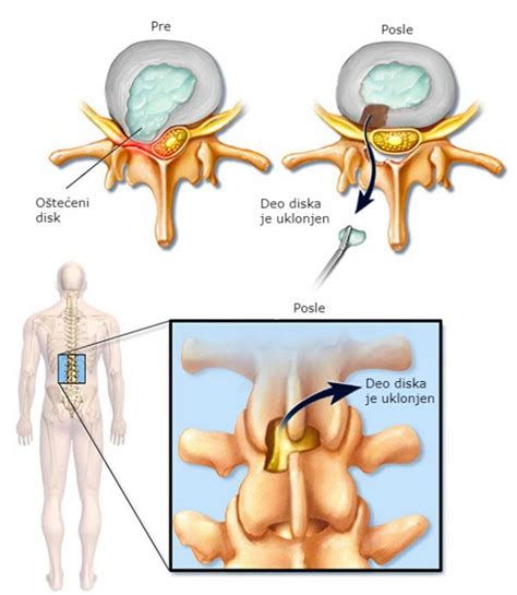 Diskus Hernija Simptomi Uzroci Dijagnoza Le Enje Spinemax