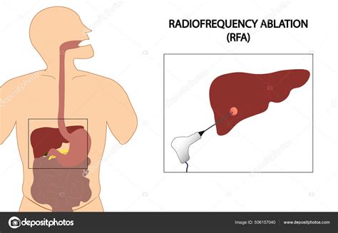 Liver Radiofrequency Ablation Rfa Illustration Liver Cancer Ablation