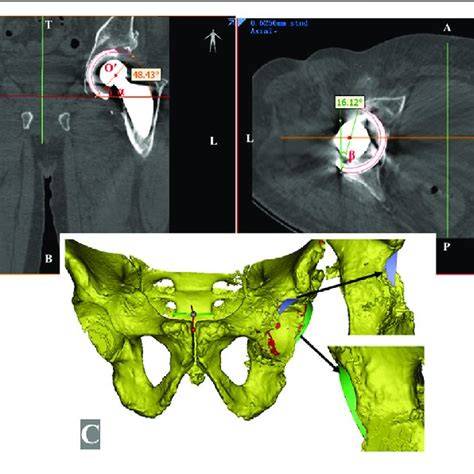 Measurement Of The Simulated Implanted Acetabular Cup On The Mimics