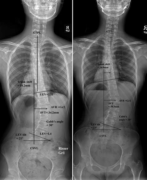 Thoracolumbar Scoliosis