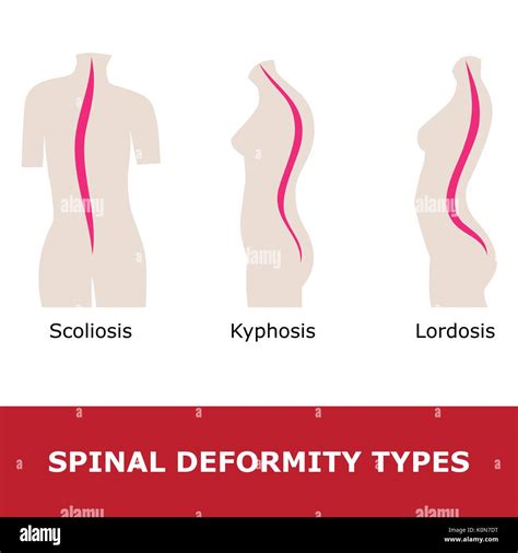 La Lordosis Escoliosis Y Cifosis Ilustración Vectorial De La