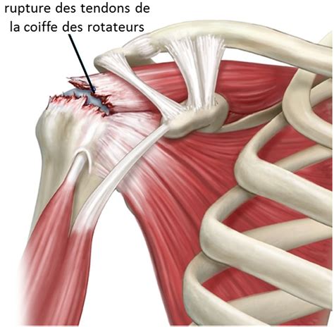 Rupture De La Coiffe Des Rotateurs R Union Arthroscopie De L Paule