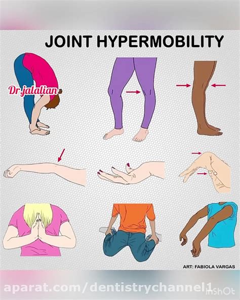 Hypermobile Joints And Joint Hypermobility Syndrome