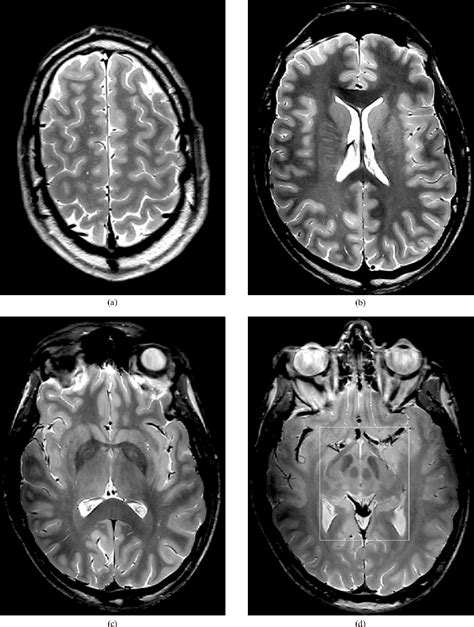 Figure 1 from High resolution MRI of the brain at 4.7 Tesla using fast spin echo imaging ...