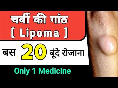 Lipoma Ka Ilaj Lipoma Lipoma Best Homeopathic Medicine Lipoma