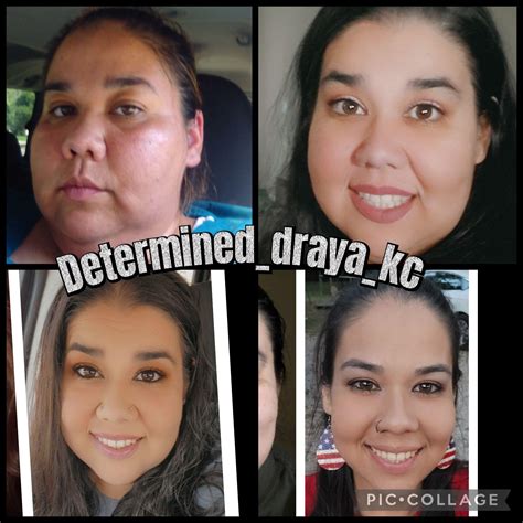 Advocating for yourself to get a panniculectomy covered by insurance