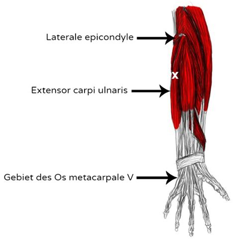 M Sculo Extensor Cubital Del Carpo Dolores Y Puntos Gatillo