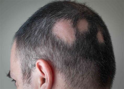 Natural Treatments For Alopecia Areata