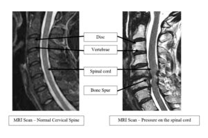 Neurosurgeonsofnewjersey Cervical Spondylotic Myelopathy Mri