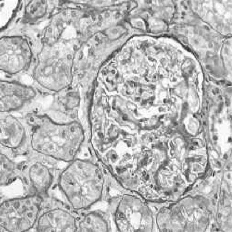 Electron Micrograph Of A Portion Of A Glomerulus Showing Diffuse