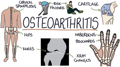 Symptoms Of Osteoarthritis And Treatment Healthpally