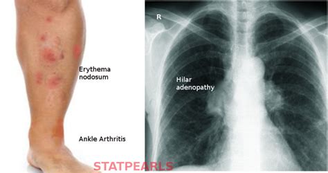 Figure Lofgren Syndrome Image Courtesy S Bhimji Md Statpearls