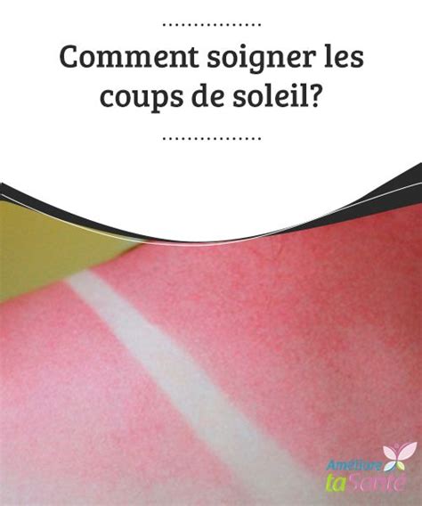 Comment Soigner Les Coups De Soleil